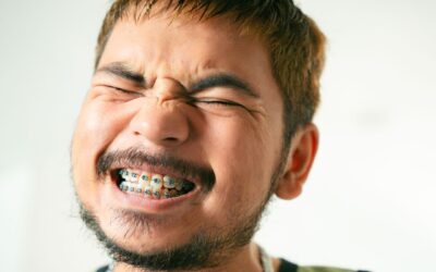 Denti storti: non è solo un problema estetico