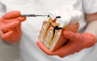 Carie: i piccoli segnali che i denti ti mandano prima di provare dolore